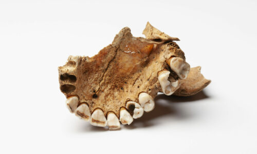 Augusta Raurica Deutliche Zeichen von Karies im Oberkiefer der Frau Foto Susanne Schenker